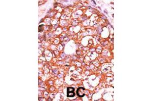 Formalin-fixed and paraffin-embedded human breast cancer tissue reacted with DUSP14 polyclonal antibody  , which was peroxidase-conjugated to the secondary antibody, followed by AEC staining. (DUSP14 anticorps  (AA 1-30))