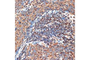 Immunohistochemistry of paraffin-embedded human esophageal cancer using FIP200 Rabbit pAb (ABIN7269881) at dilution of 1:100 (40x lens).