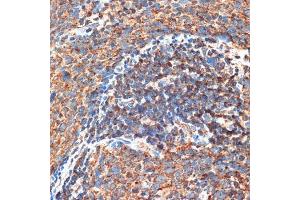 Immunohistochemistry of paraffin-embedded human esophageal cancer using FIP200 Rabbit pAb (ABIN7269881) at dilution of 1:100 (40x lens). (FIP200 anticorps  (C-Term))