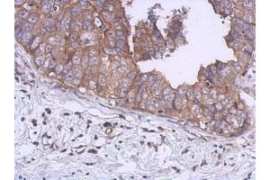 IHC-P Image Immunohistochemical analysis of paraffin-embedded human breast cancer, using UKHC, antibody at 1:500 dilution. (KIF5B anticorps  (C-Term))