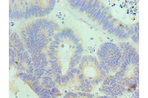 Immunohistochemistry of paraffin-embedded human colon cancer using ABIN7156833 at dilution of 1:100 (IL18RAP anticorps  (AA 390-599))