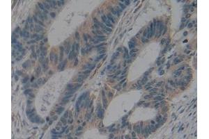 Detection of IL2Ra in Human Colorectal cancer Tissue using Polyclonal Antibody to Interleukin 2 Receptor Alpha (IL2Ra)