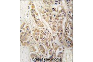 Formalin-fixed and paraffin-embedded human breast carcinoma tissue reacted with CLIC4 antibody , which was peroxidase-conjugated to the secondary antibody, followed by DAB staining. (CLIC4 anticorps)