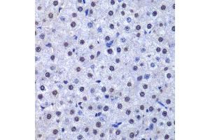 Immunohistochemistry of paraffin-embedded human liver cancer using GSTP1 antibody. (GSTP1 anticorps  (AA 1-210))