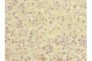 Immunohistochemistry of paraffin-embedded human liver cancer using ABIN7170191 at dilution of 1:100 (SLC25A36 anticorps  (AA 58-110))