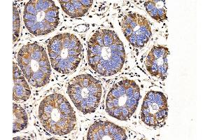 ABIN6265080 and ABIN6268997 at 1/100 staining Human colorectal cancer and adjacent normal tissues by IHC-P. (SIAH2 anticorps  (C-Term))