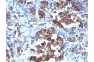 Formalin-fixed, paraffin-embedded human gastric carcinoma stained with Cdc20 antibody (CDC20/1102) (CDC20 anticorps)