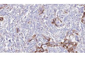 ABIN6277587 at 1/100 staining Human urothelial cancer tissue by IHC-P. (MERTK anticorps  (Internal Region))