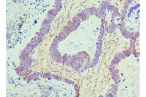 Immunohistochemistry of paraffin-embedded human ovarian cancer using ABIN7172779 at dilution of 1:100