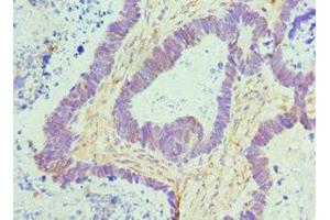 Immunohistochemistry of paraffin-embedded human ovarian cancer using ABIN7172779 at dilution of 1:100 (CTCF anticorps  (AA 1-260))
