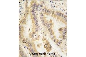 Formalin-fixed and paraffin-embedded human lung carcinoma tissue reacted with SOD2 Monoclonal Antibody (ABIN387807 and ABIN2843901) , which was peroxidase-conjugated to the secondary antibody, followed by DAB staining. (SOD2 anticorps)