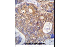 ICS Antibody (N-term) (ABIN656869 and ABIN2846073) immunohistochemistry analysis in formalin fixed and raffin embedded human colon carcinoma followed by peroxidase conjugation of the secondary antibody and DAB staining. (PAICS anticorps  (N-Term))