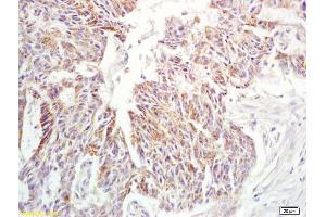 Formalin-fixed and paraffin embedded human rectal carcinoma labeled with Anti-IL-6 Polyclonal Antibody, Unconjugated (ABIN872547) at 1:200 followed by conjugation to the secondary antibody and DAB staining (IL-6 anticorps  (AA 51-150))