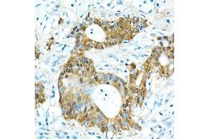 Immunohistochemistry of paraffin-embedded Human colon carcinoma using CDX2 antibody  at dilution of 1:300 (40x lens).