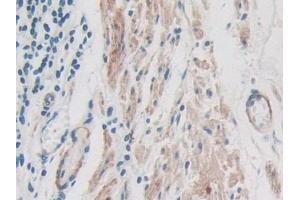 Detection of ITIH1 in Human Stomach cancer Tissue using Polyclonal Antibody to Inter Alpha-Globulin Inhibitor H1 (ITIH1) (ITIH1 anticorps  (AA 507-819))