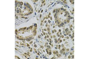 Immunohistochemistry of paraffin-embedded human breast cancer using EBAG9 Antibody (ABIN1872406) at dilution of 1:100 (40x lens). (RCAS1 anticorps)