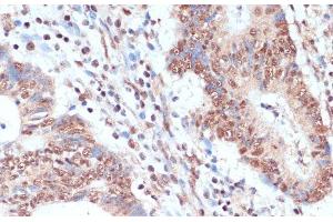 Immunohistochemistry of paraffin-embedded Human colon carcinoma using NAA20 Polyclonal Antibody at dilution of 1:100 (40x lens). (NAT5 anticorps)