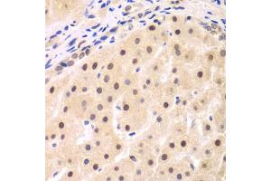 Immunohistochemistry of paraffin-embedded human liver cancer using NFKBIB antibody (ABIN6130475, ABIN6144584, ABIN6144585 and ABIN6221459) at dilution of 1:200 (40x lens).