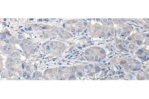 Immunohistochemistry of paraffin-embedded Human breast cancer tissue using RASSF8 Polyclonal Antibody at dilution of 1:35(x200) (RASSF8 anticorps)