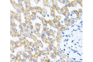 Immunohistochemistry of paraffin-embedded Human liver damage using RIPK4 Polyclonal Antibody at dilution of 1:100 (40x lens). (RIPK4 anticorps)
