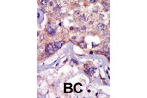 Formalin-fixed and paraffin-embedded human cancer tissue reacted with LCK polyclonal antibody  , which was peroxidase-conjugated to the secondary antibody, followed by AEC staining. (LCK anticorps  (N-Term))