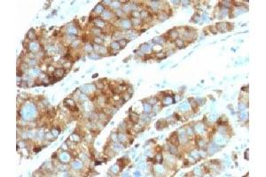 Formalin-fixed, paraffin-embedded human prostate carcinoma stained with LAMP3 antibody (LAMP3/968) (LAMP3 anticorps)