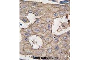 Formalin-fixed and paraffin-embedded human lung carcinoma tissue reacted with ANXA2 antibody (N-term) (ABIN391619 and ABIN2841538) , which was peroxidase-conjugated to the secondary antibody, followed by DAB staining.