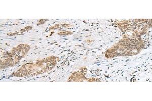 Immunohistochemistry of paraffin-embedded Human esophagus cancer tissue using CALCOCO1 Polyclonal Antibody at dilution of 1:50(x200) (CALCOCO1 anticorps)