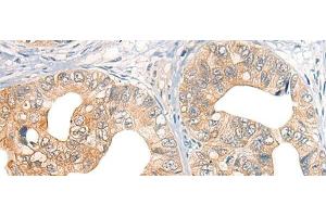 Immunohistochemistry of paraffin-embedded Human gastric cancer tissue using CORO2A Polyclonal Antibody at dilution of 1:45(x200)