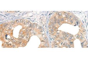 Immunohistochemistry of paraffin-embedded Human gastric cancer tissue using CORO2A Polyclonal Antibody at dilution of 1:45(x200) (CORO2A anticorps)