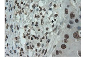 Immunohistochemical staining of paraffin-embedded Adenocarcinoma of breast using anti-IL-3 (ABIN2452543) mouse monoclonal antibody. (IL-3 anticorps  (AA 20-152))