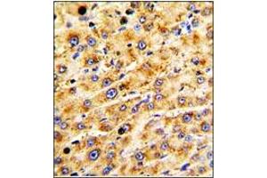 Immunohistochemistry: ADAMTS13 antibody staining of Formalin-Fixed Paraffin-Embedded Human hepatocarcinoma followed by peroxidase-conjugation to the secondary antibody and DAB staining. (ADAMTS13 anticorps  (AA 836-866))