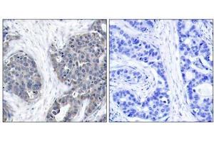 Immunohistochemical analysis of paraffin-embedded human breast carcinoma tissue using Stathmin 1 (Ab-37) antibody (E021218). (Stathmin 1 anticorps)
