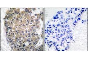 Immunohistochemistry analysis of paraffin-embedded human breast carcinoma tissue, using Keratin 17 Antibody.