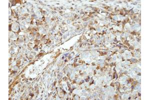 IHC-P Image Immunohistochemical analysis of paraffin-embedded CL1-0 xenograft, using GK5, antibody at 1:500 dilution. (GK5 anticorps  (Center))