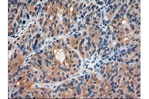 Immunohistochemical staining of paraffin-embedded Carcinoma of kidney using anti-AMY2A (ABIN2452539) mouse monoclonal antibody. (AMY2A anticorps  (AA 300-511))
