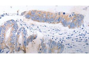 Immunohistochemistry of paraffin-embedded Human colon cancer tissue using SERP1 Polyclonal Antibody at dilution 1:30