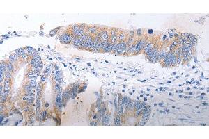 Immunohistochemistry of paraffin-embedded Human colon cancer tissue using SERP1 Polyclonal Antibody at dilution 1:30 (SERP1 anticorps)
