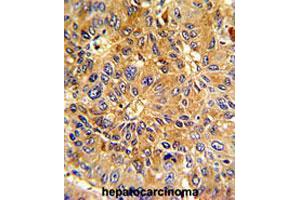 Formalin-fixed and paraffin-embedded human hepatocarcinomareacted with CCNA2 polyclonal antibody , which was peroxidase-conjugated to the secondary antibody, followed by AEC staining. (Cyclin A anticorps  (N-Term))