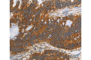 Immunohistochemistry of Human gastric cancer using PIK3C3 Polyclonal Antibody at dilution of 1:40