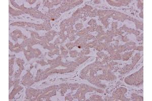 IHC-P Image PCYT2 antibody detects PCYT2 protein at cytoplasm on human breast cancer by immunohistochemical analysis. (PCYT2 anticorps)