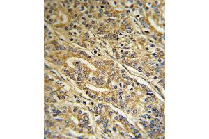 Formalin-fixed and paraffin-embedded human Prostate carcinoma reacted with ACOT8 Antibody , which was peroxidase-conjugated to the secondary antibody, followed by DAB staining.