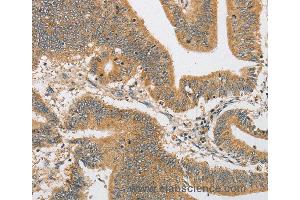 Immunohistochemistry of Human liver cancer using ARHGAP15 Polyclonal Antibody at dilution of 1:30 (ARHGAP15 anticorps)
