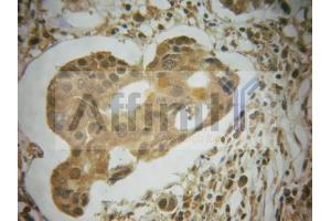 ABIN6267585 at 1/100 staining human breast carcinoma tissues sections by IHC-P. (MDM2 anticorps  (pSer166))