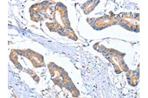 The image on the left is immunohistochemistry of paraffin-embedded Human colon cancer tissue using ABIN7130296(MTMR7 Antibody) at dilution 1/40, on the right is treated with fusion protein. (MTMR7 anticorps)
