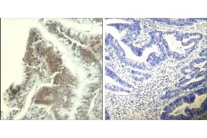 Immunohistochemical analysis of paraffin-embedded human colon carcinoma tissue using CDK6 (Ab-13) Antibody (E021542). (CDK6 anticorps)