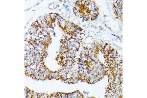 Immunohistochemistry of paraffin-embedded Human colon carcinoma using TR antibody (ABIN1683134, ABIN5664756, ABIN5664758 and ABIN6220605) at dilution of 1:100 (40x lens).