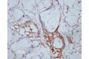 ABIN6266591 at 1/200 staining human Oral squamous cell carcinoma sections by IHC-P.