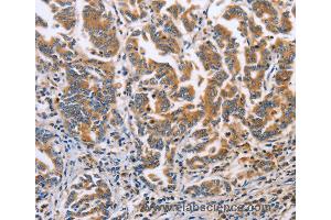 Immunohistochemistry of Human liver cancer using DOK4 Polyclonal Antibody at dilution of 1:60 (DOK4 anticorps)