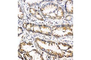 Anti-Oncostatin M antibody, IHC(P) IHC(P):Human Intestinal Cancer Tissue (Oncostatin M anticorps  (Middle Region))